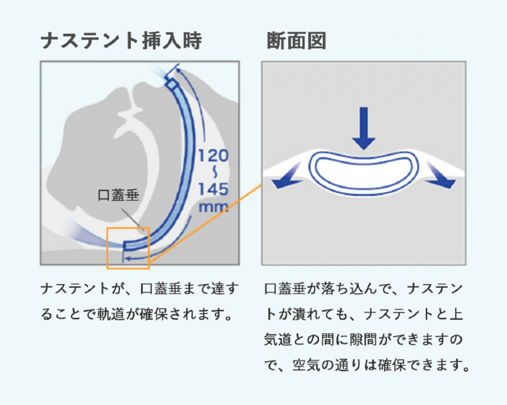 ナステントにより気道を確保する図